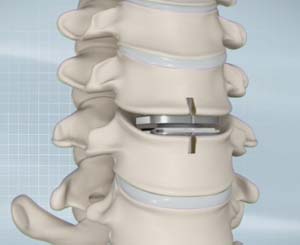 cervical-disc-replacement.jpg